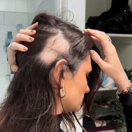 A woman parting her hair to show a patch of hair loss