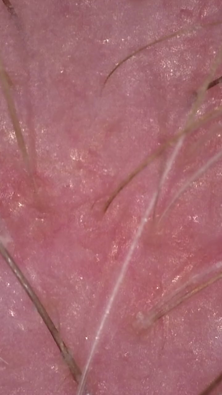 Before: TricoTest image of a client's scalp at 50 times, red and inflamed, February 2022