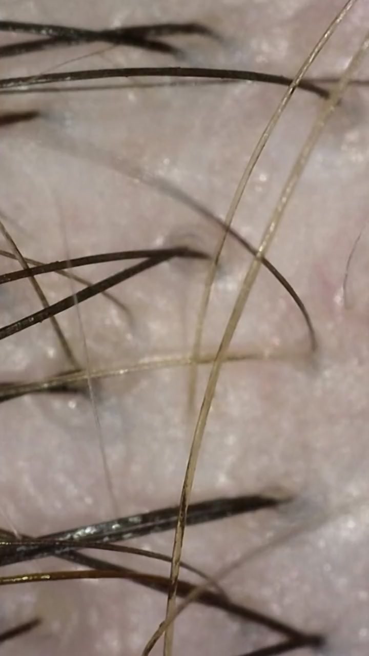 After: the same area in June 2022, calmer skin and more hair