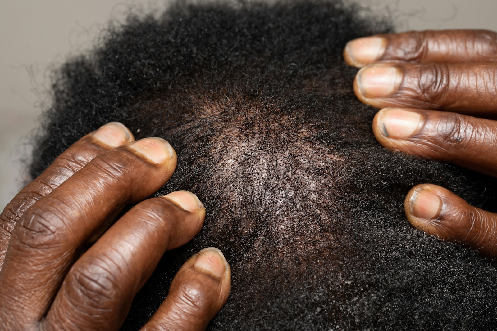 Close-up of a dry, flaking scalp