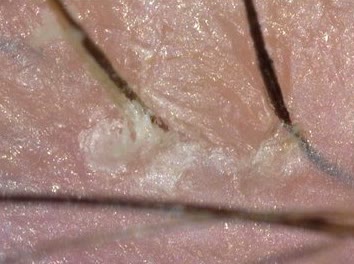 TricoTest image at 200 times showing individual hair shafts and flaking at the base