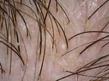 TricoTest image at 50 times showing the follicle openings across the scalp