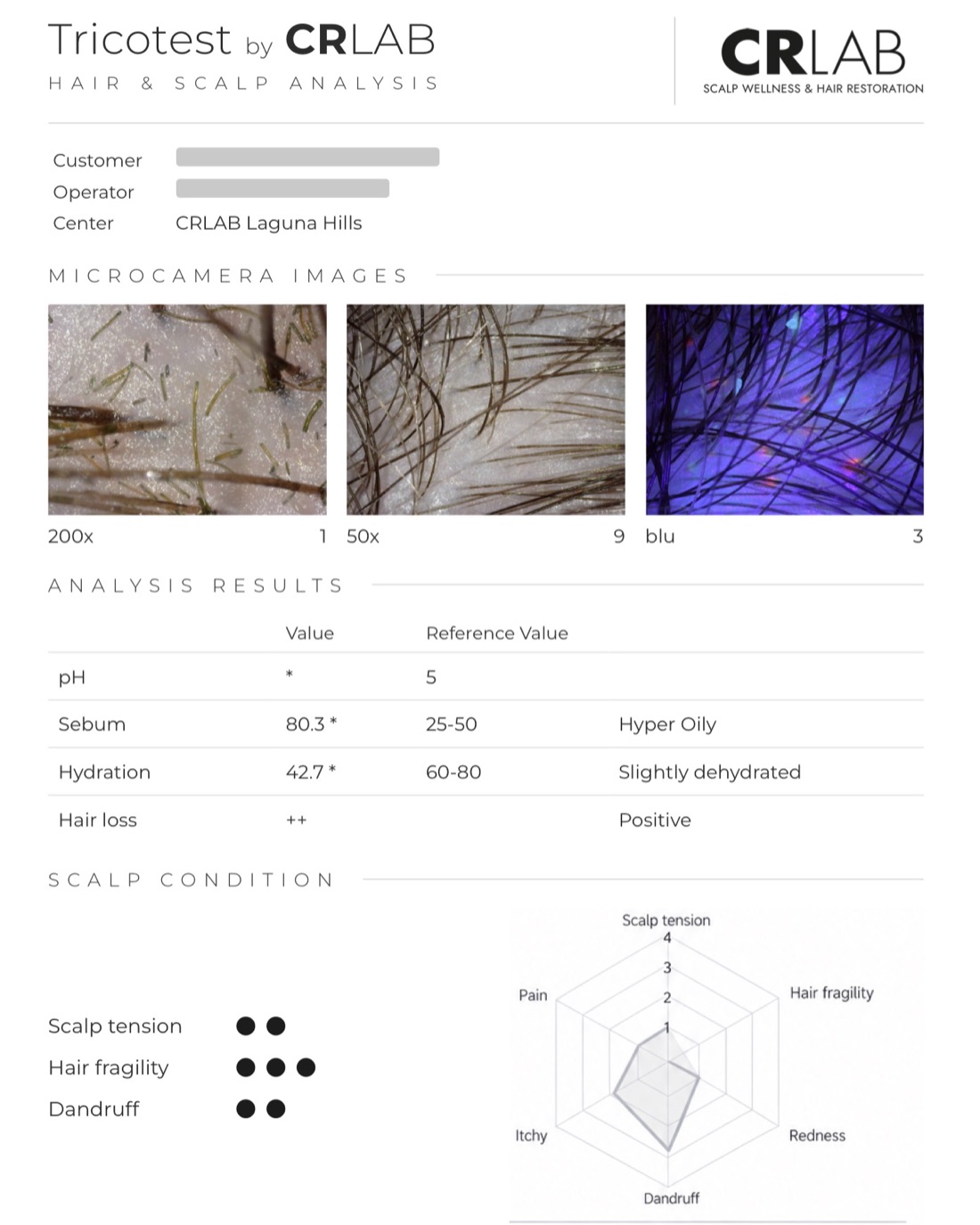 Example TricoTest® Hair & Scalp Analysis report from CRLAB Laguna Hills, with microcamera images and analysis results; client details removed